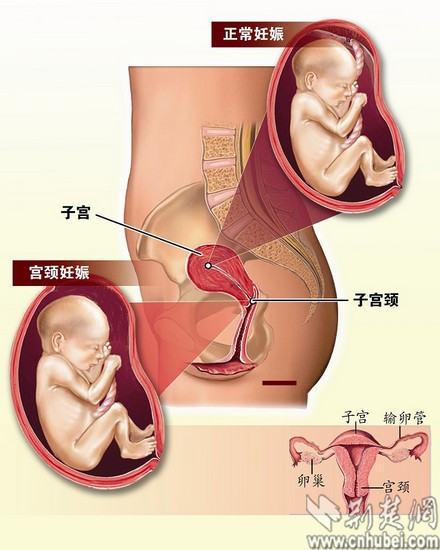 胎儿长到3个月左右就会导致宫颈破裂